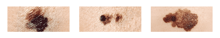 Signs of melanoma pictures